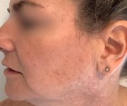 before bbl moxi left side view female patient case 2972