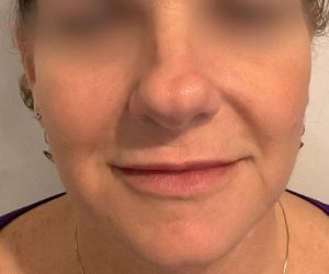after bbl moxi front view female patient case 2972