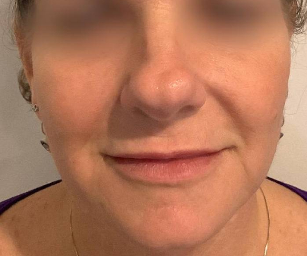 after bbl moxi front view female patient case 2972