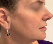after bbl moxi right side view female patient case 2972