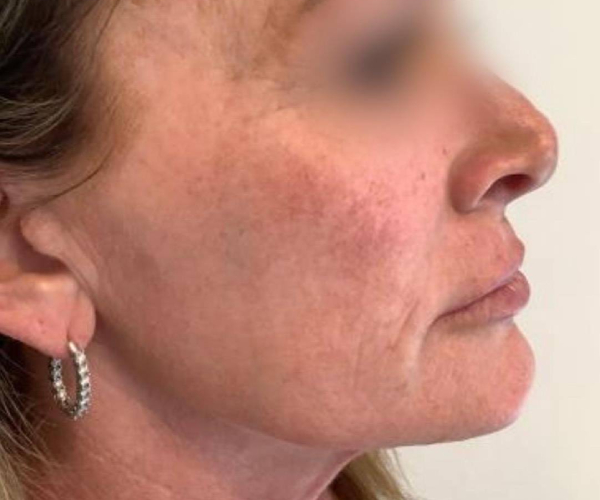 before bbl moxi right side view female patient case 2979