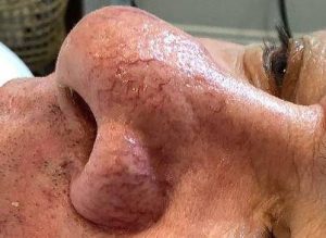 before bbl moxi left side view male patient case 2983