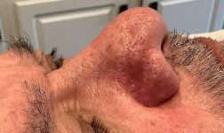after bbl moxi right side view male patient case 2983