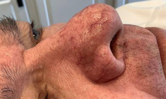 before bbl moxi right side view male patient case 2983