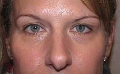 after botox female patient front view female patient case 3440