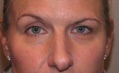 before botox female patient front view female patient case 3440