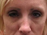 after botox front forehead view female patient case 3443