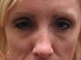 after botox front forehead view female patient case 3443