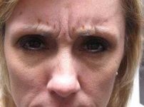 before botox front forehead view female patient case 3443