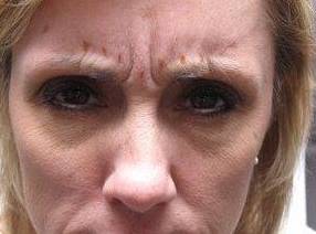 before botox front forehead view female patient case 3443