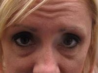 after botox front forehead view female patient case 3443