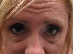 after botox front forehead view female patient case 3443