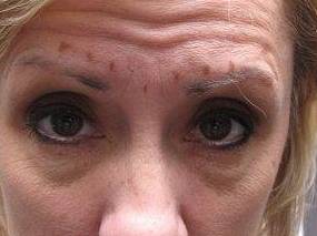 before botox front forehead view female patient case 3443