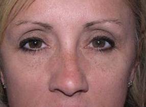 after botox female patient front forehead view female patient case 3443