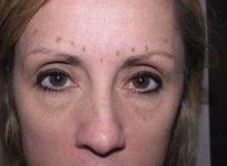 before botox female patient front forehead view female patient case 3443