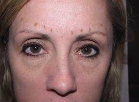 before botox female patient front forehead view female patient case 3443