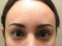 after botox forehead view female patient case 3453