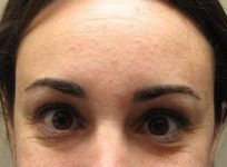 before botox forehead view female patient case 3453