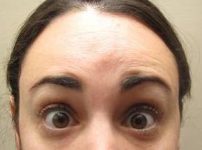 after botox forehead view female patient case 3453