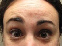 before botox forehead view female patient case 3453