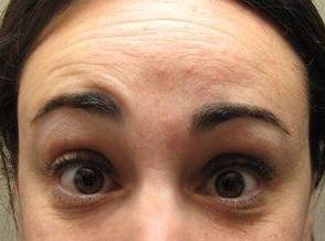 before botox forehead view female patient case 3453