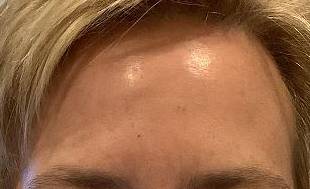 after botox forehead view female patient case 3461