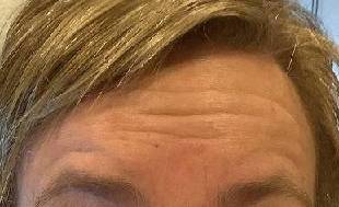before botox forehead view female patient case 3461