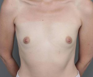 before breast augmentation front view case 1860
