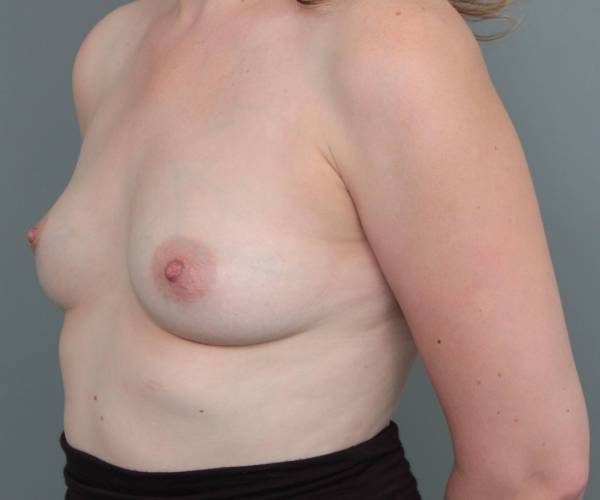before breast augmentation left angled view case 1867