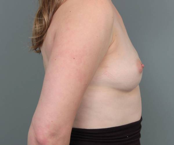 before breast augmentation right side view case 1867