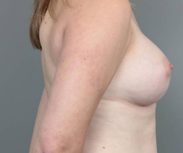 after breast augmentation right side view case 1867