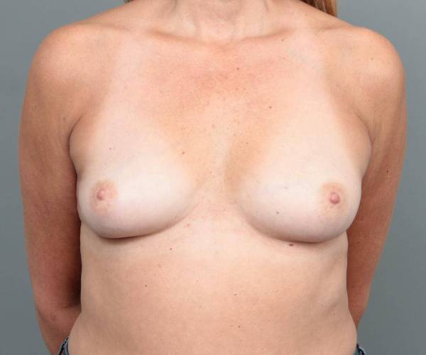 before breast augmentation front view case 1877