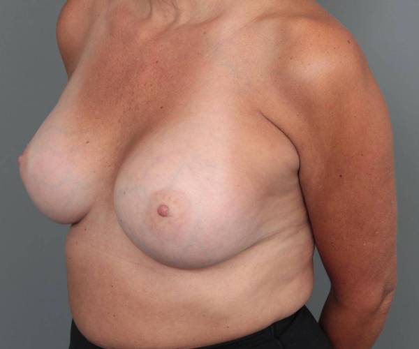 after breast augmentation left angled view case 1877
