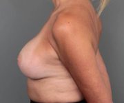 after breast augmentation left side view case 1877