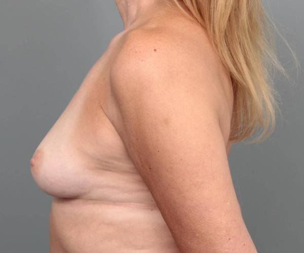 before breast augmentation left side view case 1877