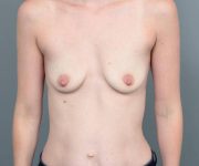 before breast augmentation front view case 1884