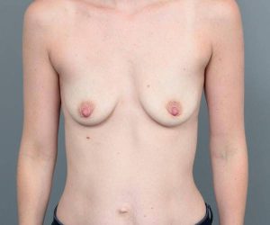 before breast augmentation front view case 1884