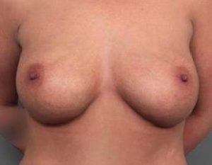 after breast augmentation front view case 1874