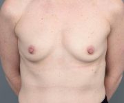 before breast augmentation front view case 1891