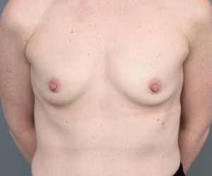 before breast augmentation front view case 1891
