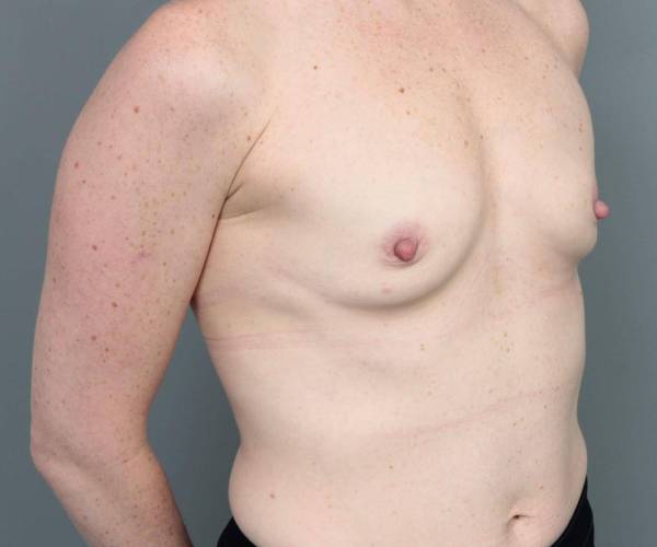 before breast augmentation right angled view case 1891