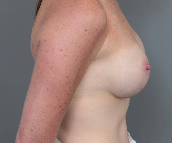 after breast augmentation right side view case 1891