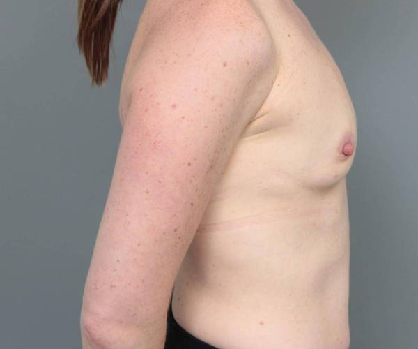 before breast augmentation right side view case 1891
