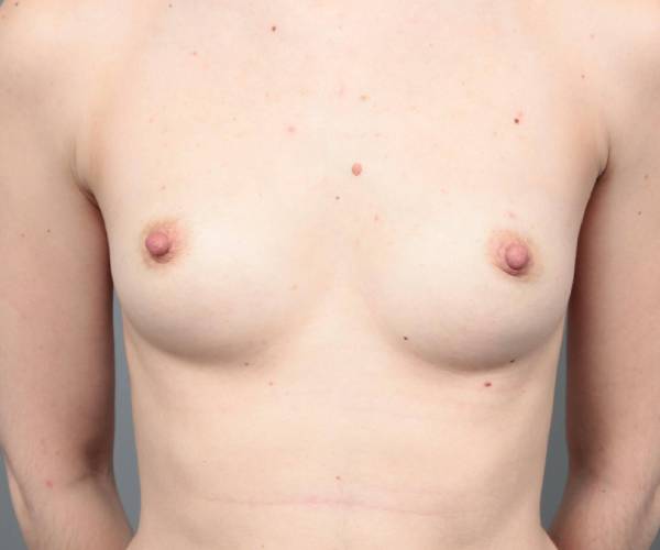 before breast augmentation front view case 1898