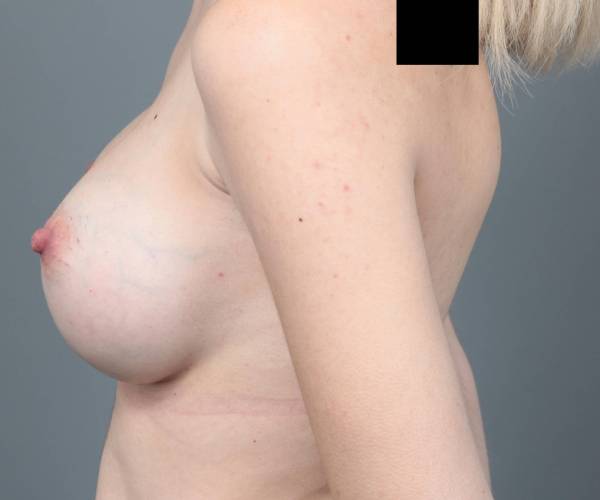 after breast augmentation left side view case 1898