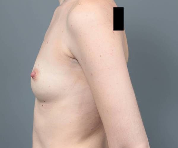 before breast augmentation left side view case 1898