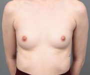 before breast augmentation front view case 1905