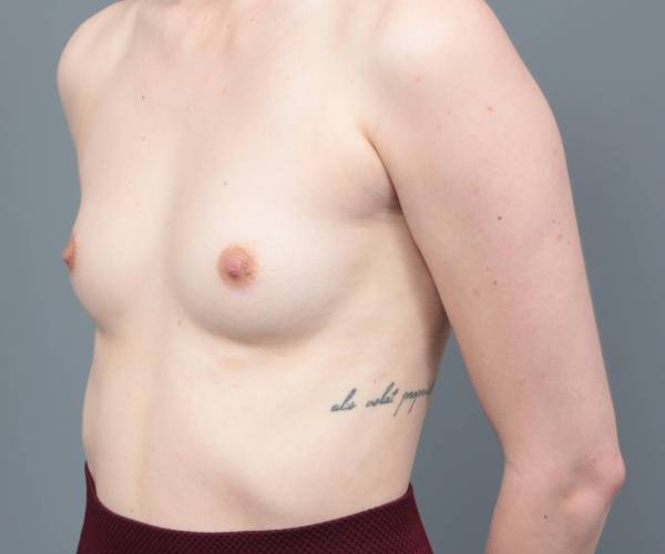 before breast augmentation left angled view case 1905