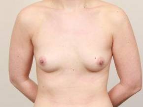 before breast augmentation front view case 1926