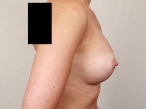 after breast augmentation right side view case 1926